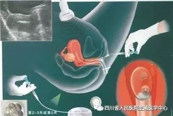 湘雅医院赠卵试管婴儿的费用是多少？