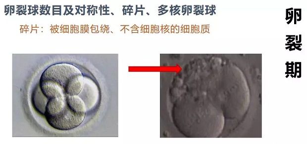子宫内膜炎试管成功了